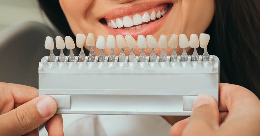 teeth palette with different shades of teeth near female smiling. Stomatology, whitening teeth, tooth implant